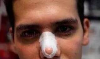 整形鼻子需要多少钱